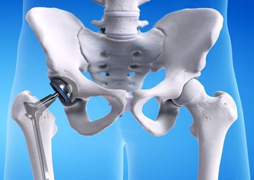 Total-Kalca-Protezi-Olan-Hastalarin-Dikkat-Etmesi-Gerekenler Total Kalça Protezi Nedir?