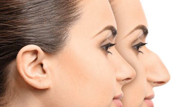 Rinoplasti Nedir ?