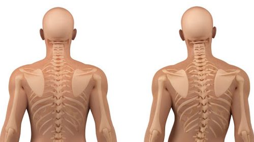 skolyoz Skolyoz Nedir?