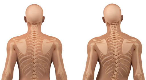 skolyoz Skolyoz Nedir?